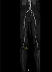 Peripheral Arterial Disease