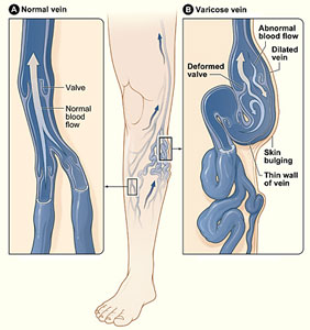 Varcoise Veins